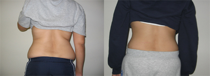 wrap back