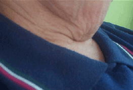 cellulite chin