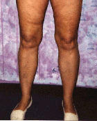 after cellulite legs