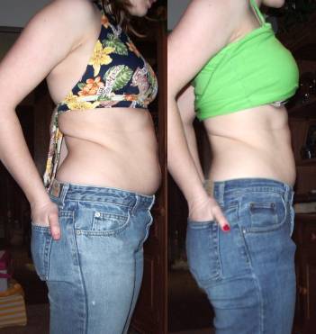 cellulite abdominal