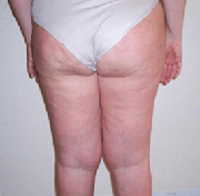 cellulite legs