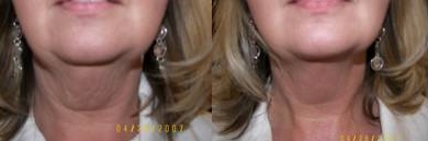 cellulite neck results