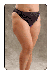cellulite thighs