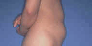 stomach cellulite