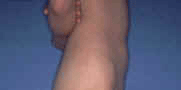 stomache cellulite after