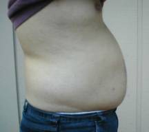 tummy cellulite