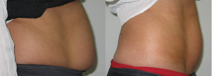 stomach fat