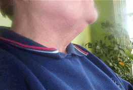 chin after mesotherapy