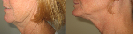 mesotherapy alternative results