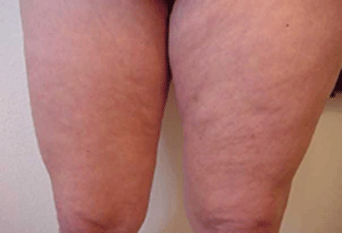 mesotherapy alternative