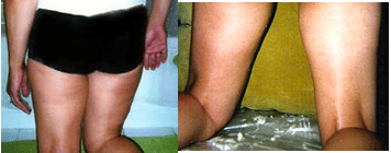mesotherapy thighs