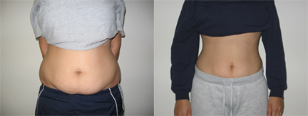 belly fat