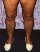 leg fat reduced