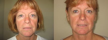 neck fat reduced